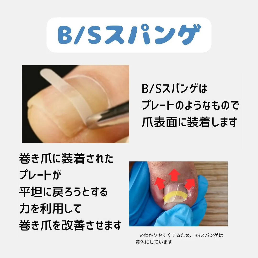 メニュー紹介🌟B/S巻き爪プレート