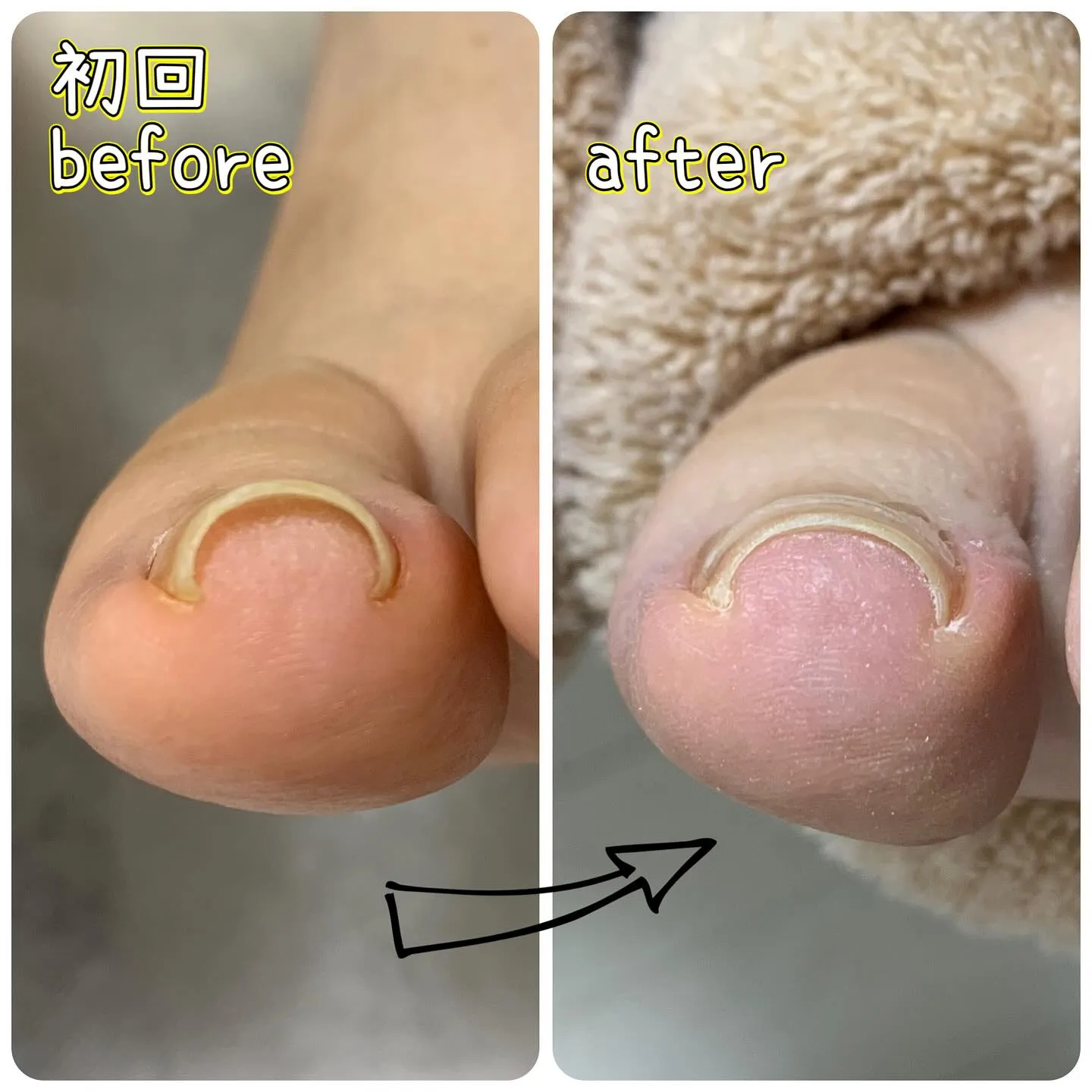 メニュー紹介🌟B/S巻き爪プレート